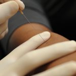 How dry needle treatment is better than acupuncture treatment?
