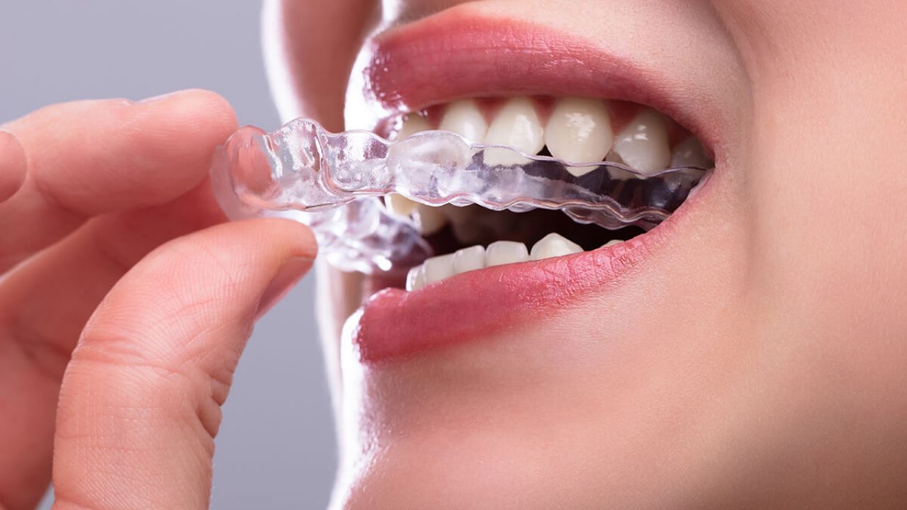 Clear Aligners Helps